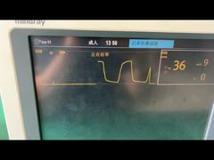 Una mirada más cercana: Trampa de agua Mindray para el módulo de gas de anestesia pediátrico para adultos 9200-10-10530